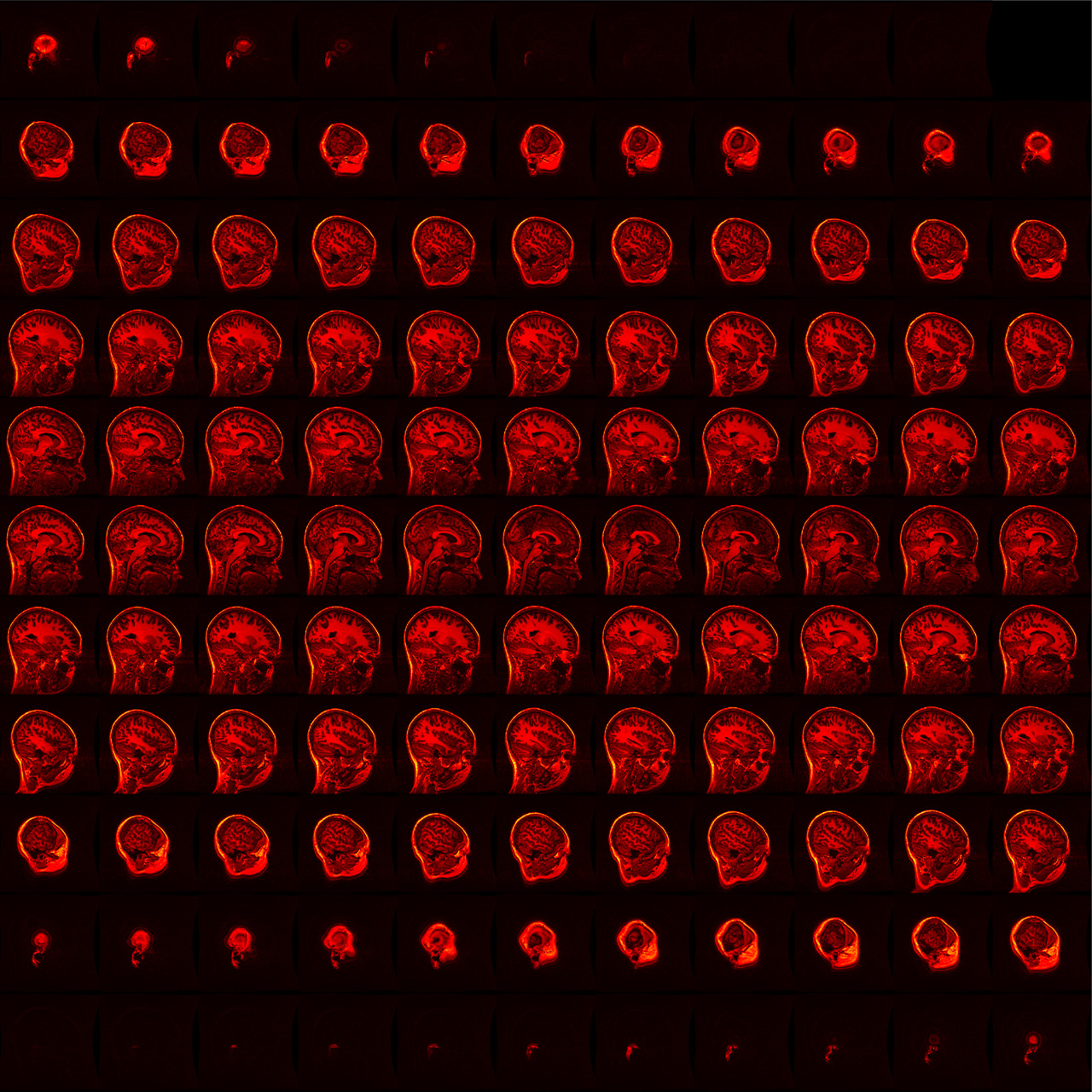 Your MRI Report: What Does It All Mean? What Now?