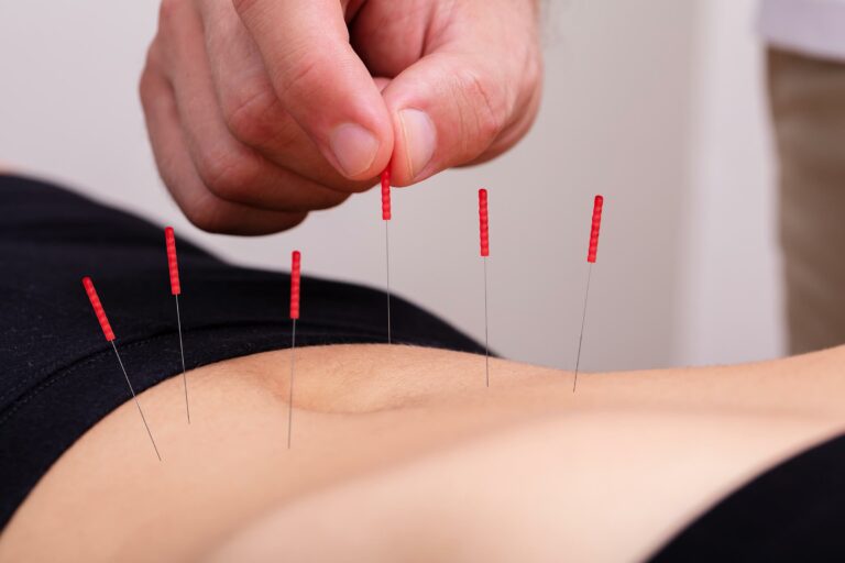 Acupuncture dry needling therapy in Sydney