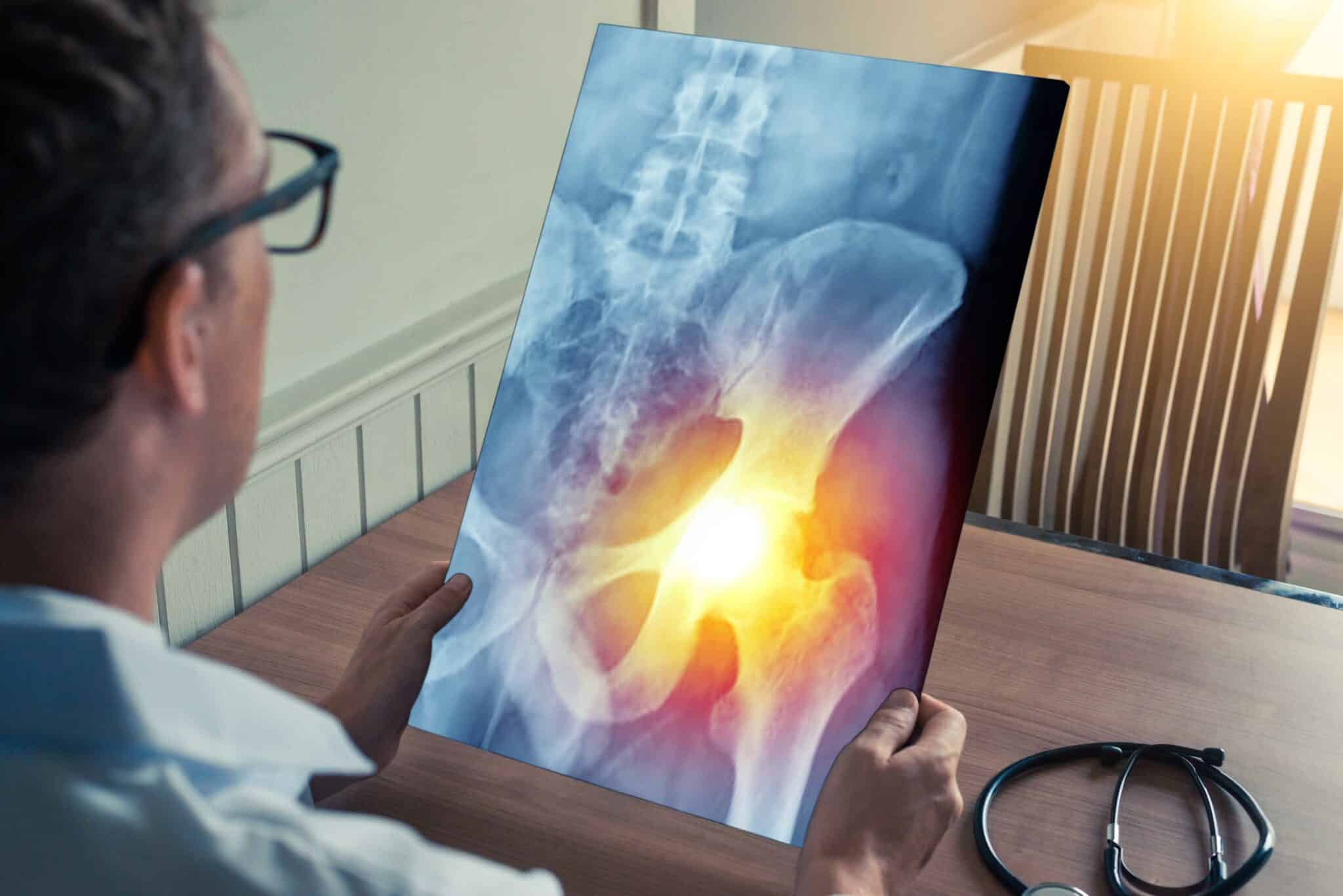 Debunked: Imaging Results Explain Chronic Hip Pain